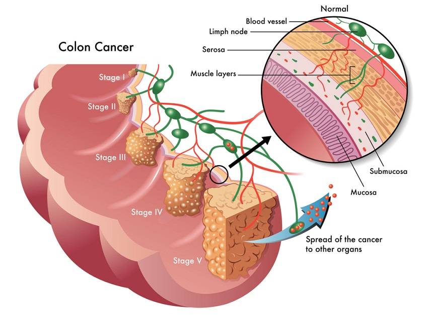 Here Is How This 70 Year Old Man Naturally Cured His Late Stage Colon 
