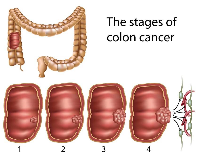 Colon Cancer Stages