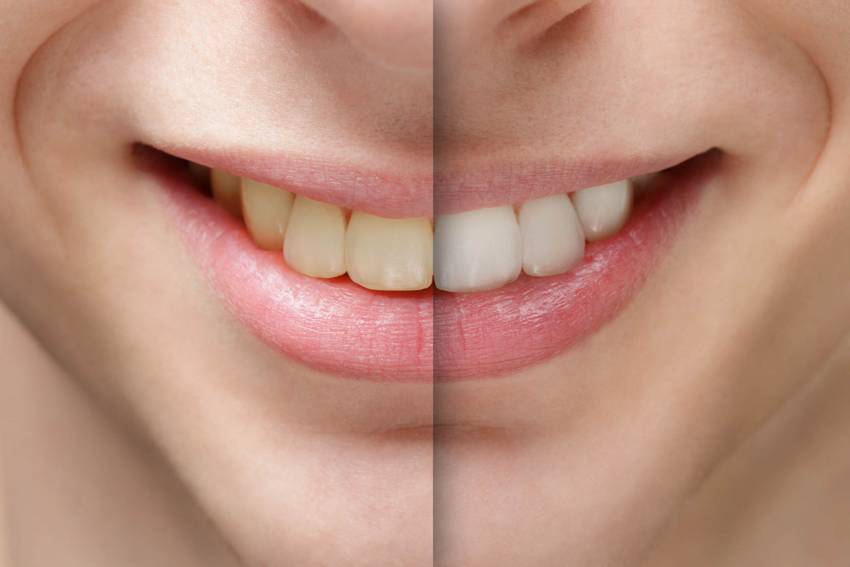 Whiten Your Teeth at Home