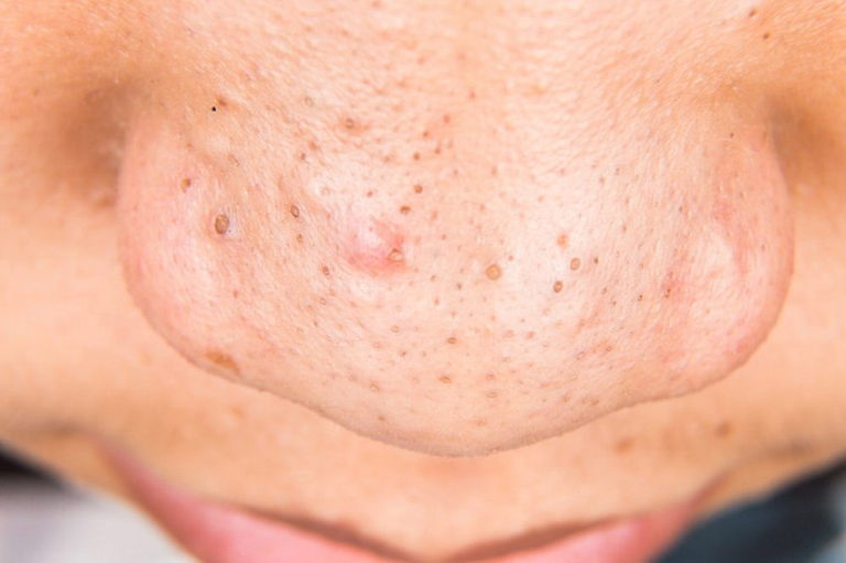 Read more about the article How to Get Rid of Blackheads Fast with This Simple Home Remedy