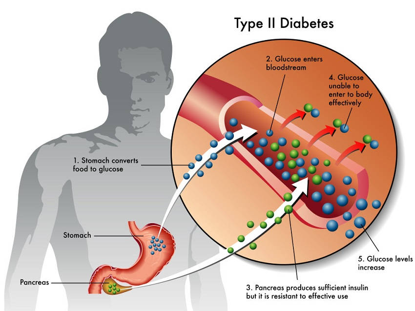 Early Diabetes Symptoms