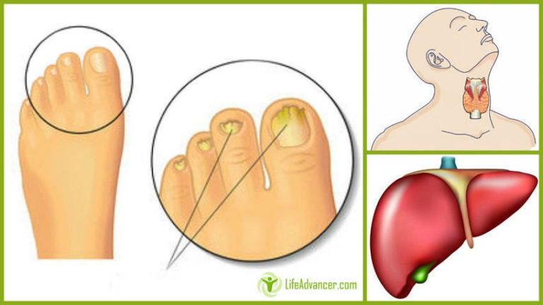 Read more about the article What Yellow Nails Can Tell You about Your Liver, Thyroid and More