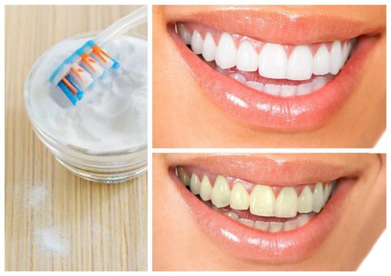 Read more about the article How to Whiten Your Teeth Naturally in Minutes at Home