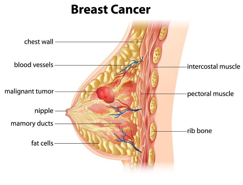Woman Breast Cancer