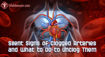4 Silent Signs of Clogged Arteries and What to Do to Unclog Them
