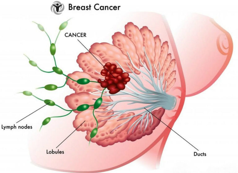 Read more about the article 10 Habits of European Women That Reduce the Risk of Breast Cancer