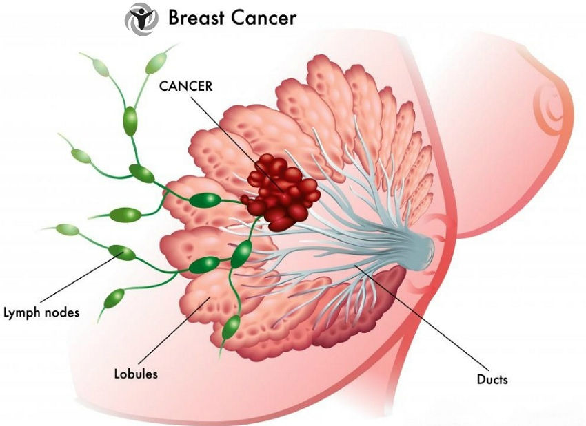 Habits European Women Reduce Risk of Breast Cancer