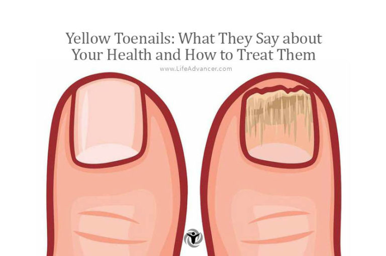 Read more about the article Yellow Toenails: What They Say about Your Health and How to Treat Them