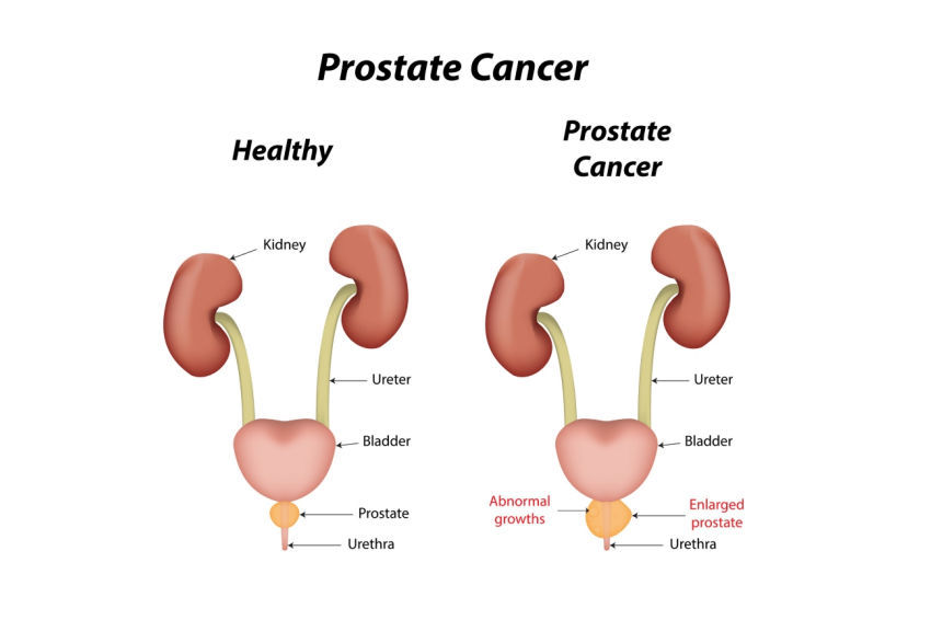 What is prostatitis and what causes it