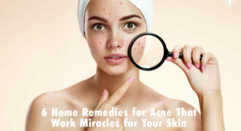 6 Home Remedies for Acne That Work Miracles for Your Skin