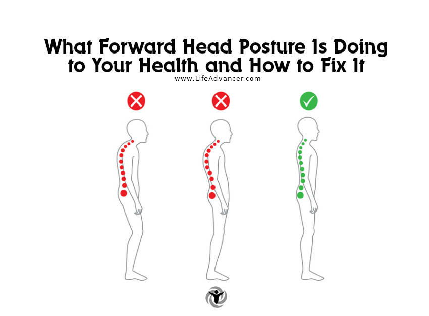 Forward Head Posture