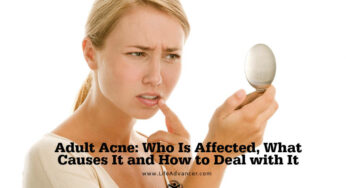 Adult Acne: Who Is Affected, What Causes It and How to Deal with It