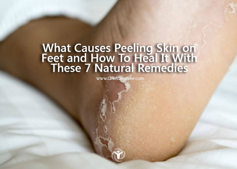 Read more about the article What Causes Peeling Skin on Feet and How to Heal It with 7 Natural Remedies