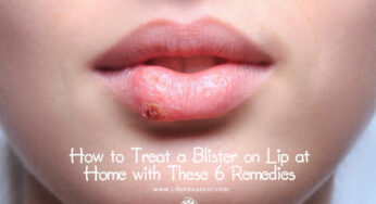 How to Treat a Blister on Lip at Home with These 5 Remedies