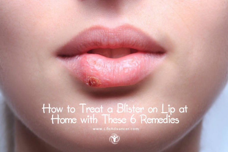 Read more about the article How to Treat a Blister on Lip at Home with These 5 Remedies