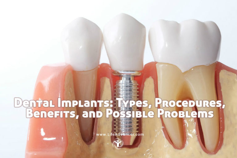 Read more about the article Dental Implants: Types, Procedures, Benefits, and Possible Problems