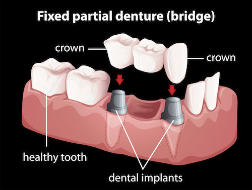 dental bridge - dental implant