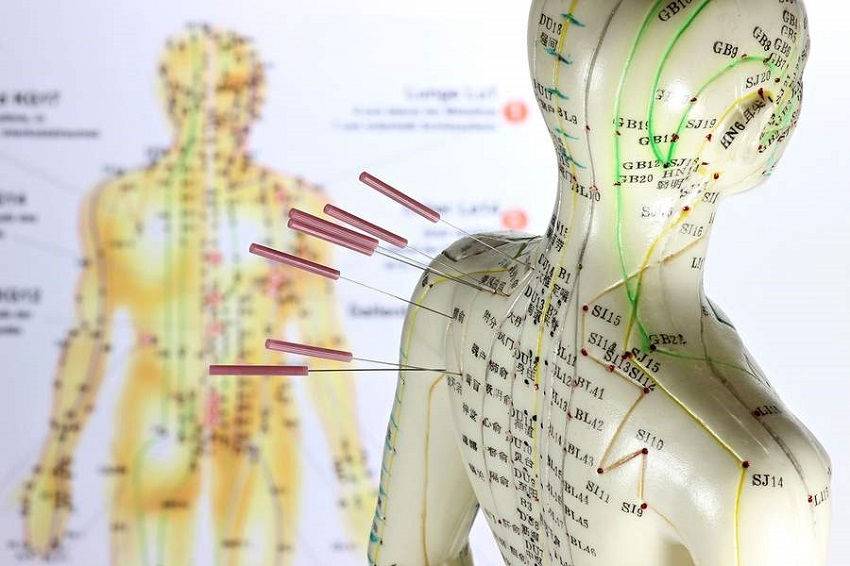 Acupuncture for anxiety works