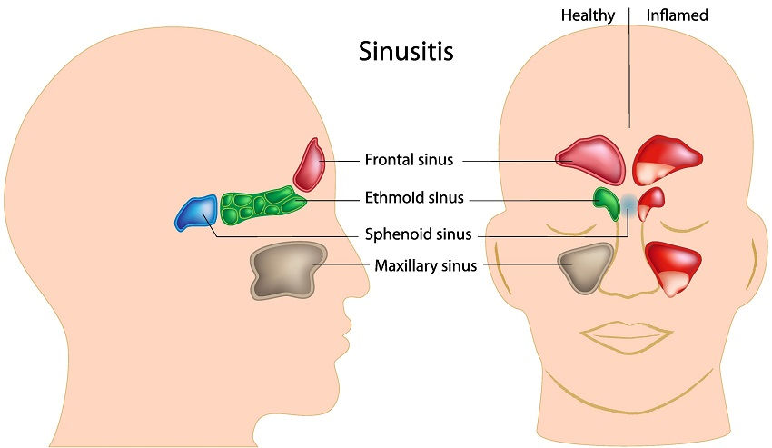 Sinusite - The 10 Most Common Sinus Headache Symptoms