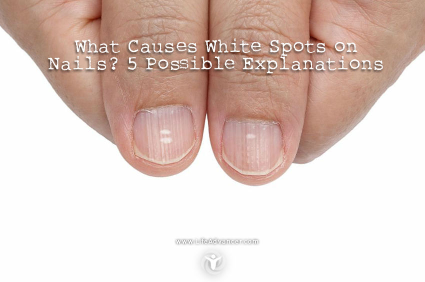 What Causes White Spots on Nails? 5 Possible Explanations