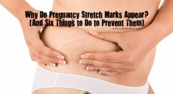 Why Do Pregnancy Stretch Marks Appear and How to Prevent Them?