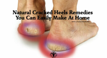 Natural Cracked Heels Remedies You Can Easily Make at Home