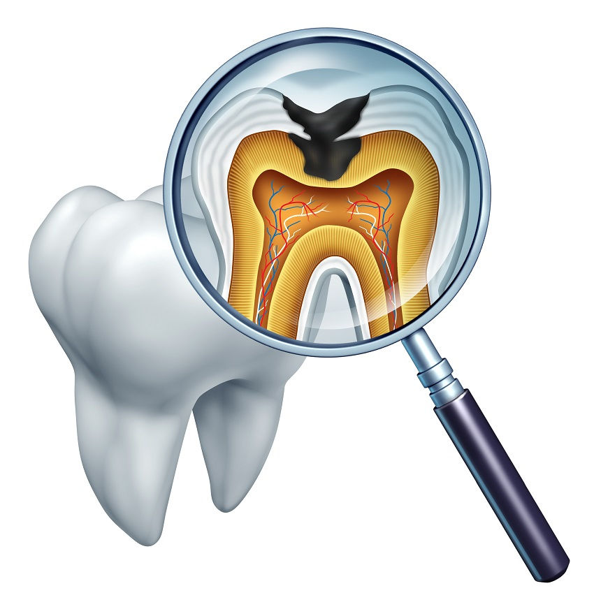 Tooth Enamel Erosion Symptoms