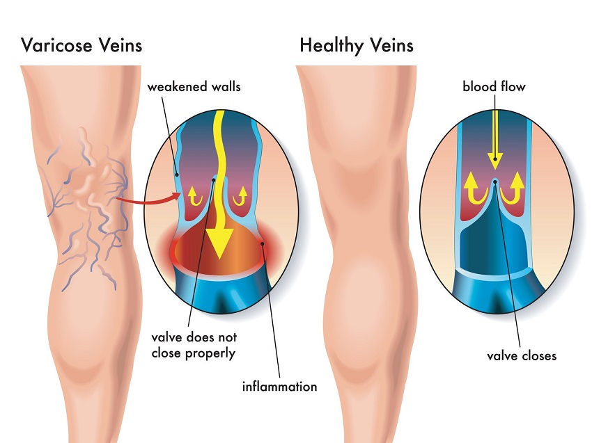 what causes varicose veins