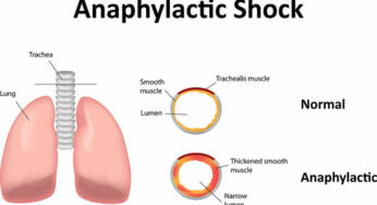 13 Anaphylactic Shock Symptoms and Things That Cause Them