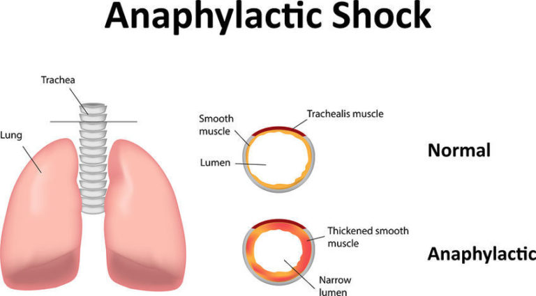 Read more about the article 13 Anaphylactic Shock Symptoms and Things That Cause Them