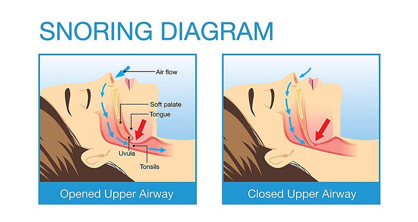 Snoring Diagram - Upper Airway