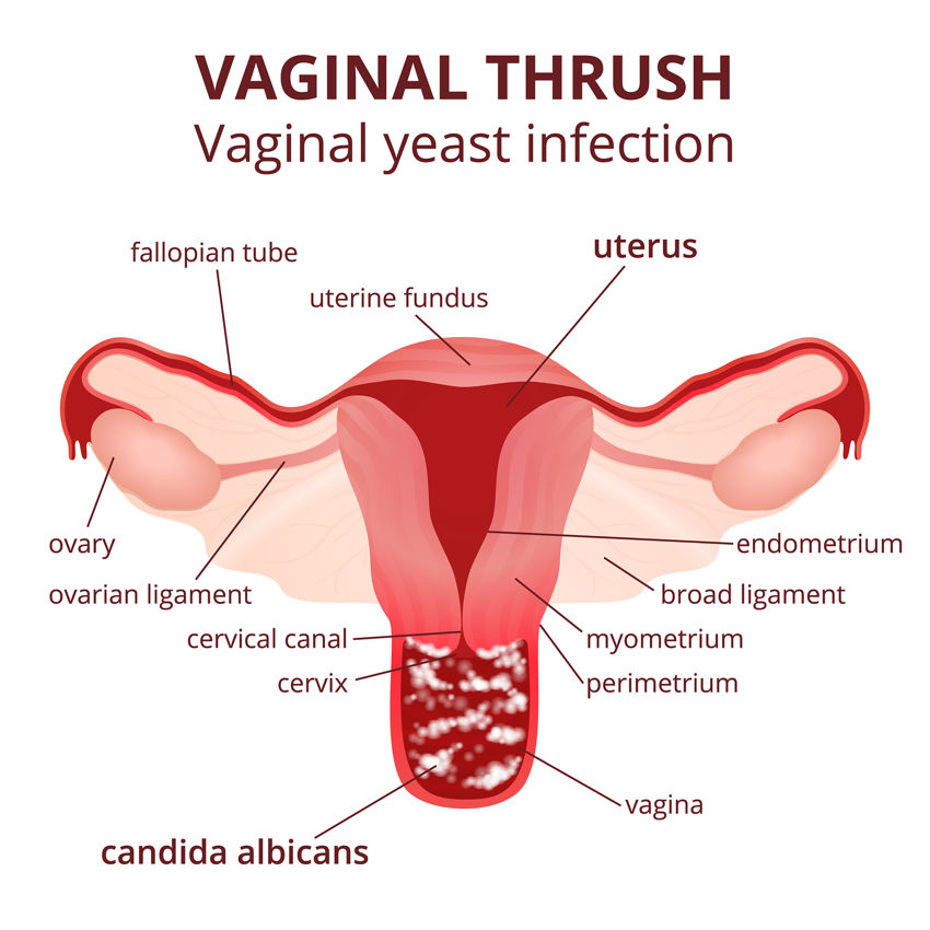 Vaginal Yeast infections