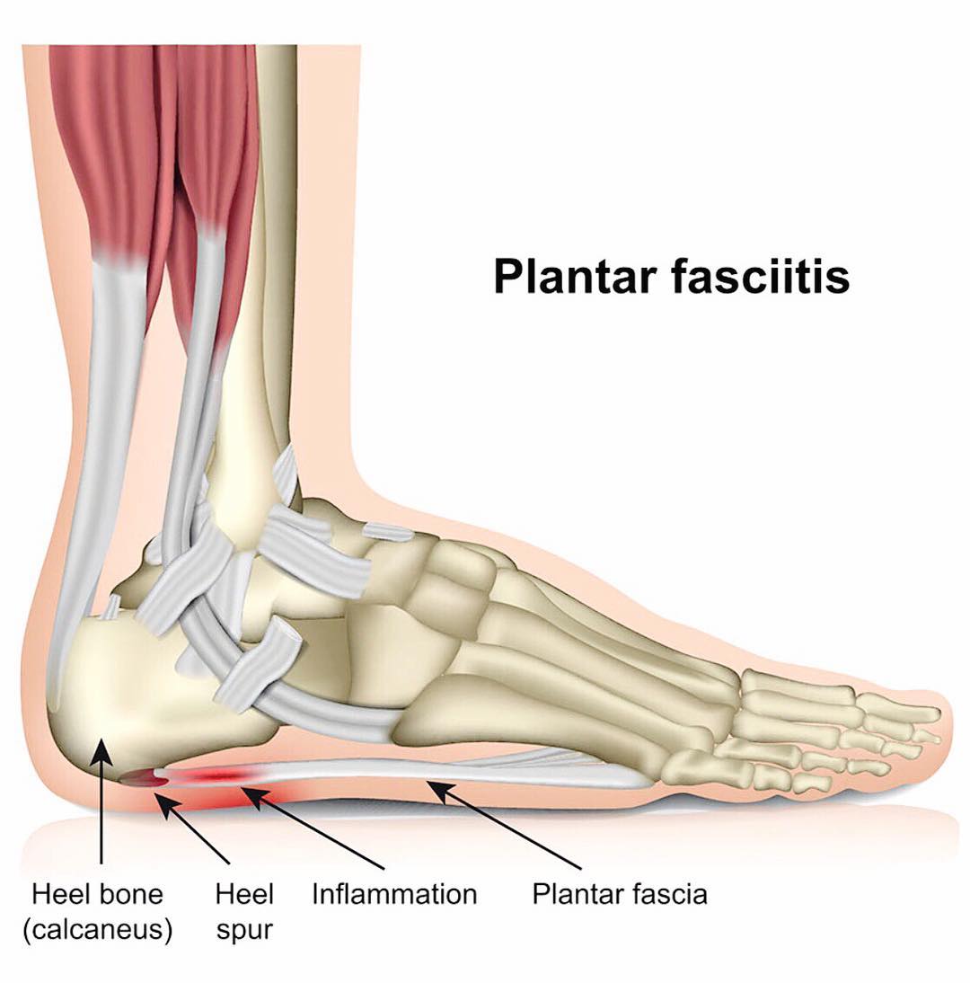 What Is Plantar Fasciitis Pain